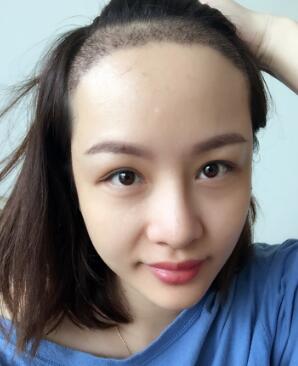 植發(fā)，種發(fā)際線真實(shí)案例分享