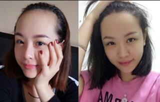 植發(fā)前后對比圖,種發(fā)際線