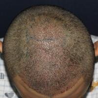 北京微創(chuàng)植發(fā)價格23800元，植發(fā)過程多圖對比分享