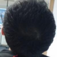 北京微創(chuàng)植發(fā)價格23800元，植發(fā)過程多圖對比分享