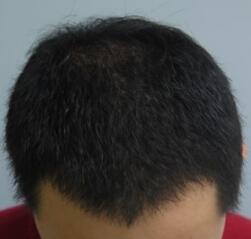 植發(fā)4個月了，期間有正常脫發(fā)