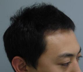 植發(fā)半年了，頭發(fā)沒有再掉落的情況，用手扒扯了一下，長的很牢固