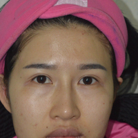 我做的面部年輕化自體脂肪面部填充大家看看怎么樣