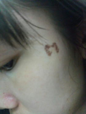 激光祛斑，還我靚白肌膚!