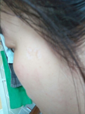 激光祛斑，還我靚白肌膚!