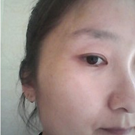 真人記錄了彩光嫩膚前后過程，果真的還不錯