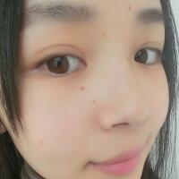 臉上激光去痣日志分享，一共去痣2次