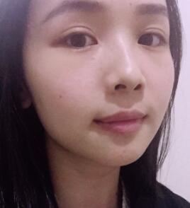 激光去痣恢復(fù)圖