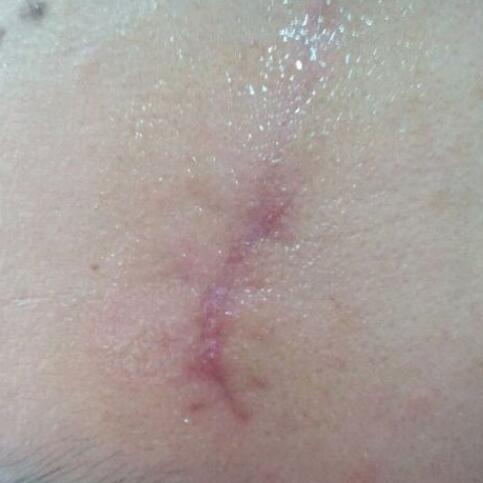 分享下我的手術(shù)切除祛疤過程路給大家做個參考