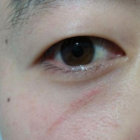 分享下我的手術(shù)切除祛疤過程路給大家做個參考