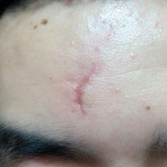 分享下我的手術(shù)切除祛疤過程路給大家做個參考