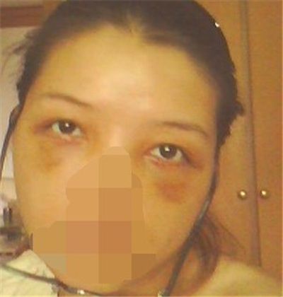 外切去眼袋手術(shù)過(guò)程和恢復(fù)前后對(duì)比照片分享，劉志飛醫(yī)生做的~