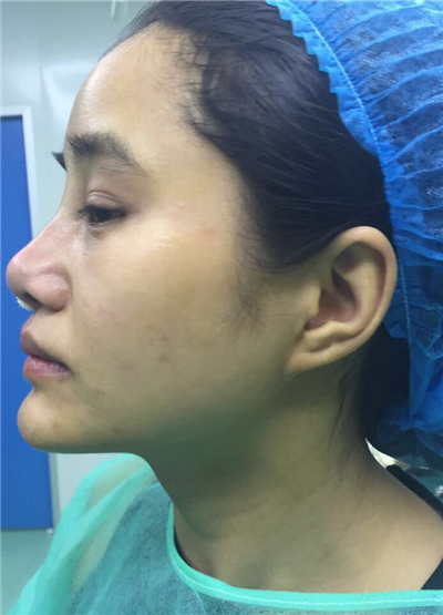 我做自體脂肪隆鼻手術(shù)恢復(fù)過程和前后對比果圖片分享哦~