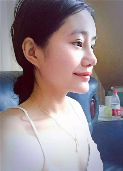 我做自體脂肪隆鼻手術(shù)恢復(fù)過程和前后對比果圖片分享哦~