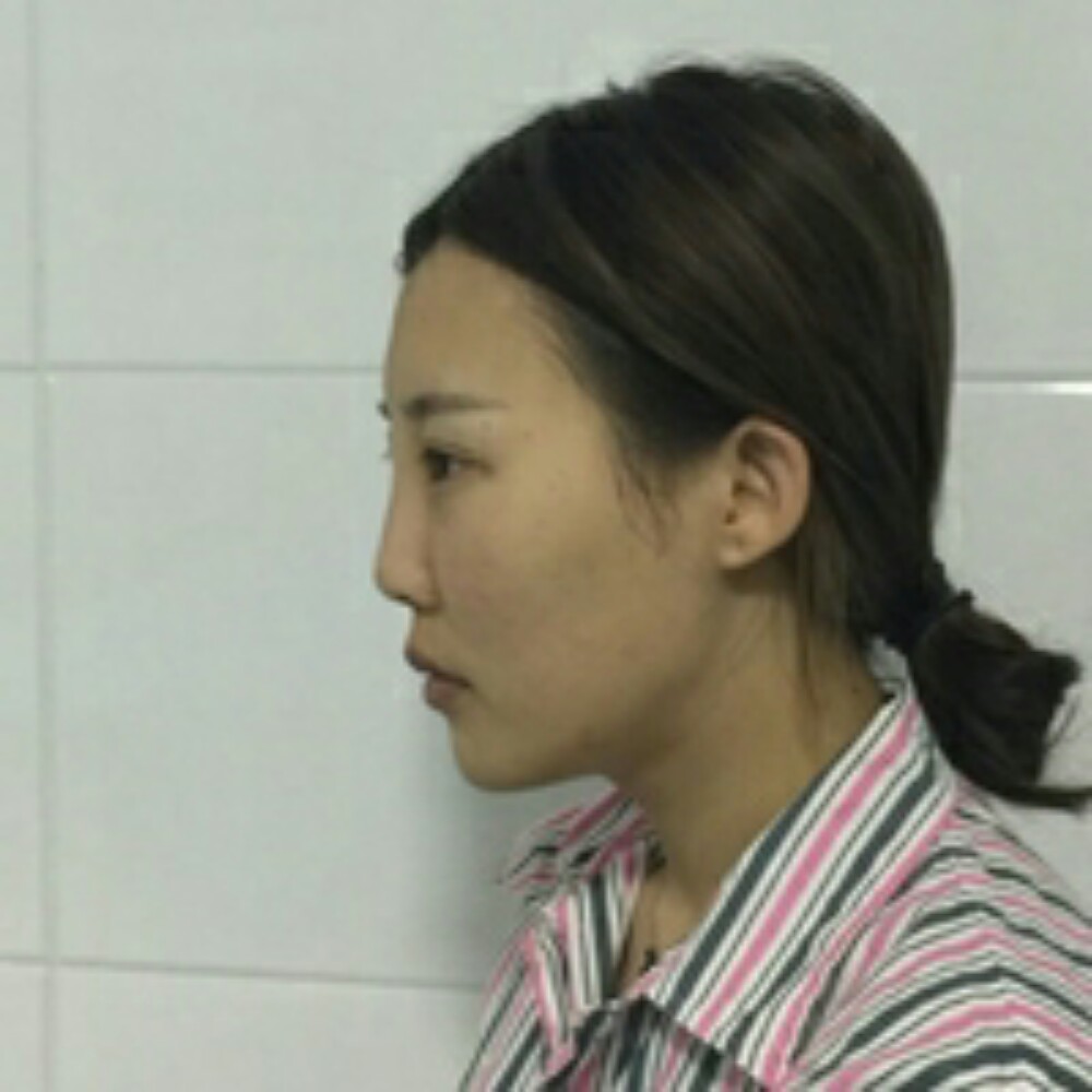 耳軟骨隆鼻尖+自體脂肪填充全臉恢復(fù)前后對比果照片分享~