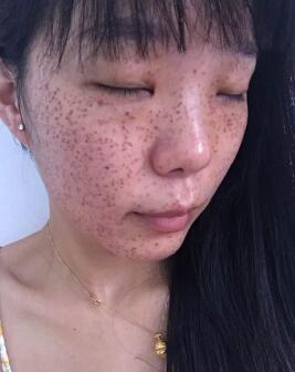 激光去雀斑真實(shí)經(jīng)歷分享