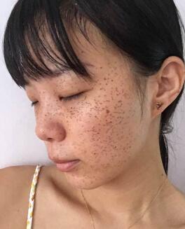 激光去雀斑對(duì)比圖