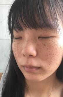 激光去雀斑第五天