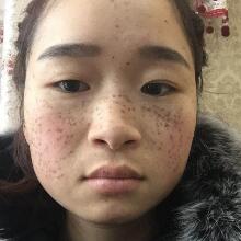 在南京光爾美醫(yī)療美容醫(yī)院做的激光祛斑緩解分享