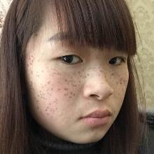 在南京光爾美醫(yī)療美容醫(yī)院做的激光祛斑緩解分享