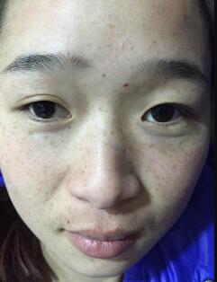 下圖是激光祛斑之前的照片