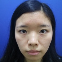 硅膠假體隆鼻+耳軟骨墊鼻尖大家看看果還不錯吧