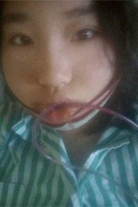 下頜角切除手術之后，我也變成小V臉了!