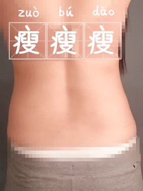 腰腹吸脂手術后，我也擁有“小蠻腰”啦!