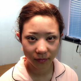 切開雙眼皮+開內(nèi)眼角手術(shù)前后過程，還有對(duì)比照片喲!