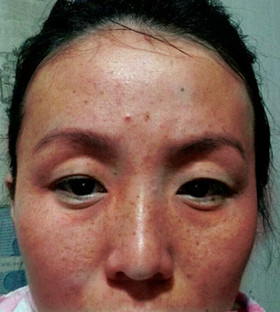 激光祛痘后終于讓我擺脫了“痘友”行列!