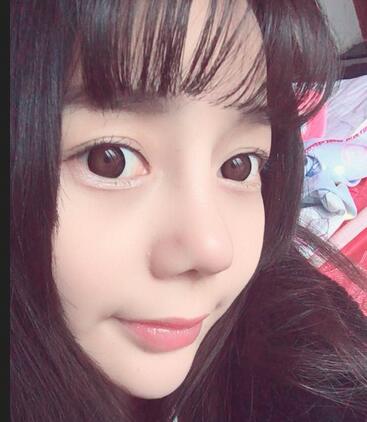 隆鼻修復(fù)術(shù)后恢復(fù)期經(jīng)歷