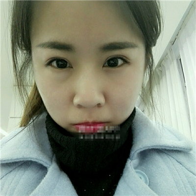 注射瘦臉去魚尾紋恢復(fù)過程和前后對(duì)比果圖片分享，上海東方做的~