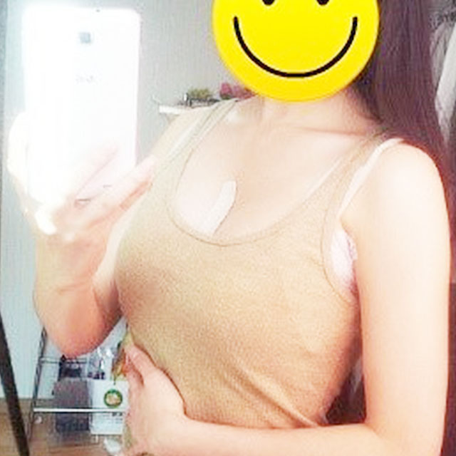 自體脂肪移植隆胸恢復過程和前后對比果圖片分享哦~