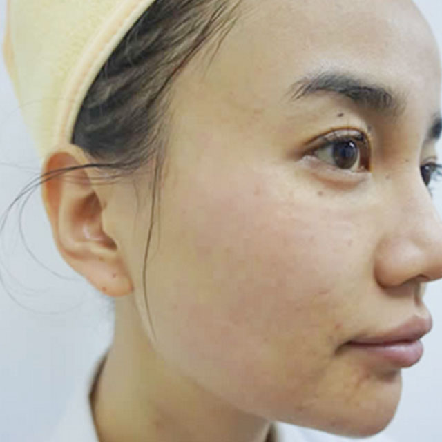 分享我的光子嫩膚經歷，還有前后對比果照片哦~