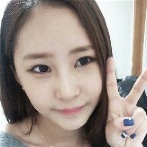 北京柏麗李勁良做的隆鼻整形，分享術(shù)后恢復果照片~