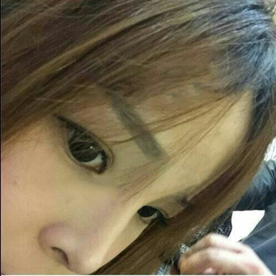 玻尿酸注射隆鼻三個(gè)月了，分享術(shù)后恢復(fù)照片哇~