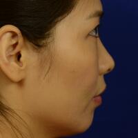 去醫(yī)院做了面部埋埋蛋白線.提升，肌膚緊致果不錯(cuò)