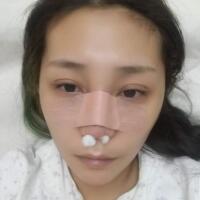 做鼻部綜合整形真是一件正確的決定，鼻子恢復(fù)過程分享