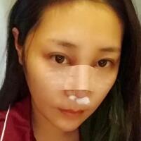 做鼻部綜合整形真是一件正確的決定，鼻子恢復(fù)過程分享