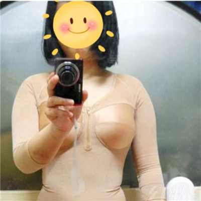 腰腹部吸脂減肥手術(shù)恢復(fù)過程和前后對(duì)比果圖片分享~