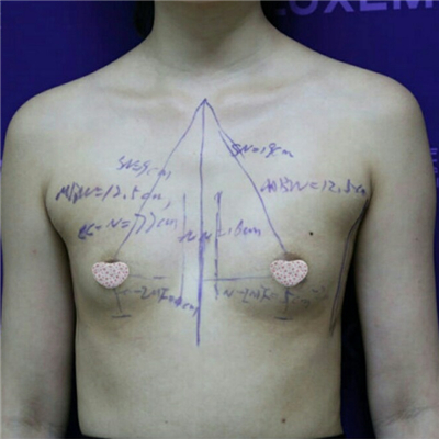 膨體假體隆胸手術過程分享，還有前后對比果照片哦~
