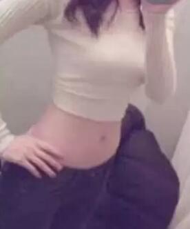 吸脂減肥手術3個多月了