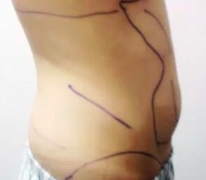 水動力吸脂減肥瘦腰腹，吸脂價格為11800元