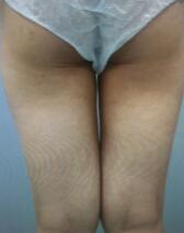 吸脂減肥瘦大腿術前