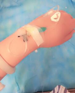 吸脂手術之后便在躺著輸液