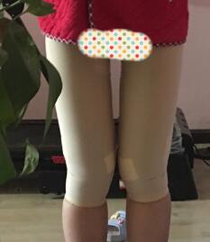 大腿吸脂第三天