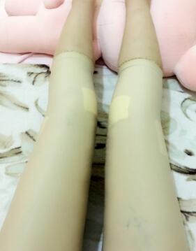 吸脂減肥瘦大腿第8天了，今天去拆線