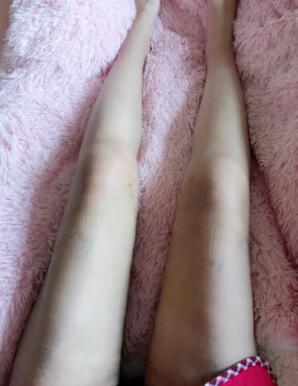 大腿吸脂手術后一直沒有洗腿，不敢洗，怕傷口感染
