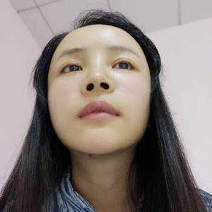 做了自體脂肪填充面部，臉部一下子就飽滿了不少!