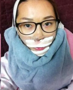 地包天手術前后過程以及對比照，真實案例分享